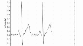 ECG App Plotting