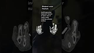 Multifragmented displaced fracture of lower end of radius noted involving articular surface.