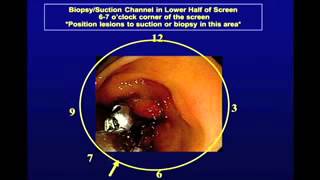 Tips and Tricks for Teaching Upper and Lower GI Endoscopy