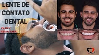 Lentes de Contato Dentais - Veja o procedimento COMPLETO e RESULTADO| Dentista em Fortaleza |