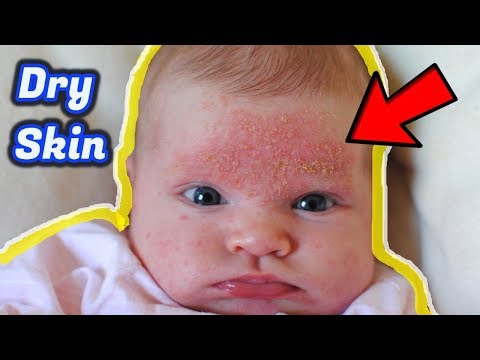 Baby Dry Skin Care | Home Remedies for Dry skin #NaturalRemedies Baby Dry Skin Care | Home Remedies for Dry skin #NaturalRemedies