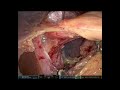 unedited robotic fundoplication video