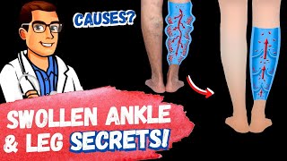 STOP Swollen Ankles & Swollen Feet [Treatment SECRETS 2024]!