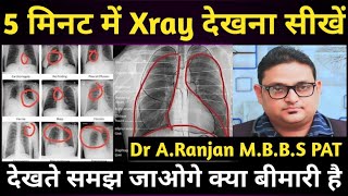 Chest X Ray देखना सीखें 5 मिनट असान भाषा में | How to read chest xray | Pneumonia | Lungs Effusion