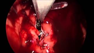 Laparoscopic Transgastric Drainage of Complex Peripancreatic Fluid Collections