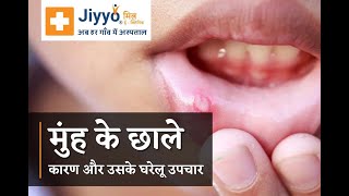 मुंह के छाले(Mouth Ulcers) - कारण और उसके घरेलू उपचार!