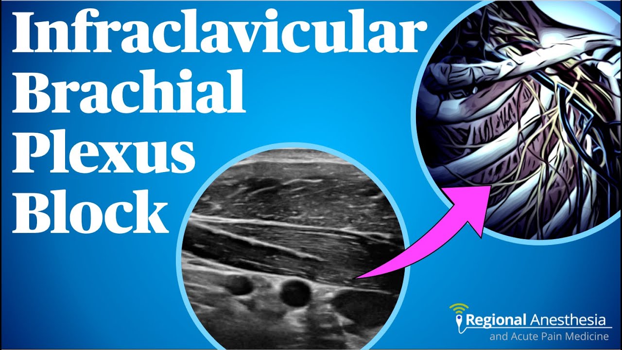 Infraclavicular Brachial Plexus Block - YouTube