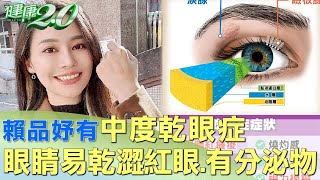 賴品妤有中度乾眼症 眼睛易乾澀紅眼.有分泌物 健康2.0 @tvbshealth20