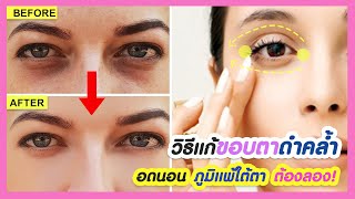 How to get rid of deep eyes, hollowed eyes, dark circles and wrinkles under the eyes naturally.