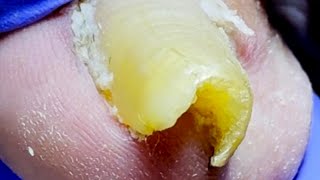 Toenails Become Bridge Holes, Perfect For Removal!  [Dr. Liu's Pedicur]