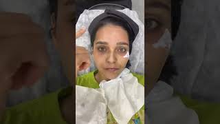 MNRF treatment- first session #microneedling #radiofrequency