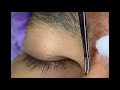 blackheads on nose and forehead best pimple popping videos