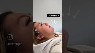 Watch me balance this facial profile using chin filler 💉