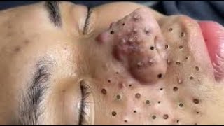 Extreme Blackhead Removal On Nose Satisfying Deep Cleansing