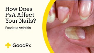 Psoriatic Arthritis Nail Changes: What Do They Look Like? | GoodRx