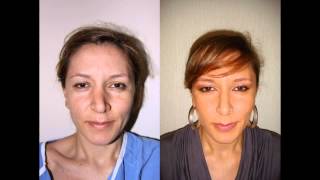 Latino \u0026 Hispanic Female Rhinoplasty NYC Before \u0026 After Dr. Sam Rizk