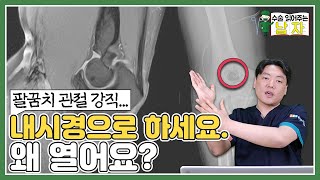 팔꿈치 관절 강직.. 내시경으로 하세요 왜 열어서 해요?｜팔꿈치 관절 강직 케이스｜수술 읽어주는 남자👨‍⚕️