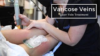 Getting Rid of Varicose Veins | Laser Spider Vein Treatment