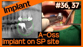 [Online Surgery] OneGuide surgery on #36, #37 after socket preservation using A-Oss