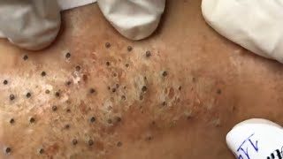 pimple,popper,extraction,blackhead,whitehead,milia,asmr,cyst,skin