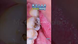 Cavity Treatment \u0026 Filling Procedure #CavityFilling #ToothDecay  #OralHealth #Dentist #ToothFilling