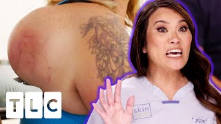 "It's Lipoma Impossible!" Dr. Lee Removes A 6lb Lipoma From A Woman's Back | Dr. Pimple Popper