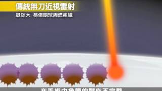 z-lasik 新無刀近視雷射 - 原理篇