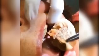 Popping huge blackheads and Pimple Popping - Best Pimple Popping Videos #62