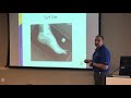 6 Atlantic Health Foot & Ankle Injuries   Turf Toe Clinical Presentation