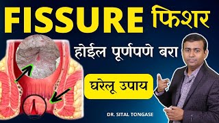 FISSURE फिशर  होईल पूर्णपणे बरा ! घरेलू उपाय Marathi #fissure #fissuretreatment #bawasir