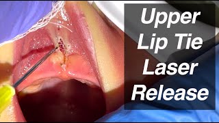 Upper Lip Tie Laser Release #2