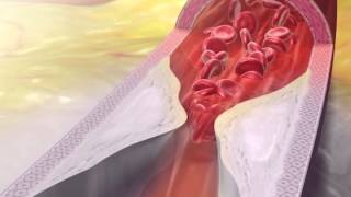 Myocardial Infarction: Learn@Visible Body