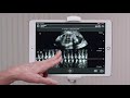 clarius feature ob fetal heart rate