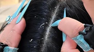 ASMR Sleep Aid 💤 Calming Scalp Routine to Melt Stress Away