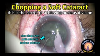 chopping a soft cataract -- here is my secret for nucleus division