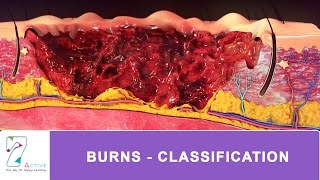 BURNS - CLASSIFICATION