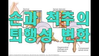 손과 척추의 퇴행성 변화 문의 Osteoarthritis