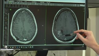 HealthWatch: New Technology to Fight Brain Tumors