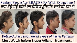 Sunken Face After Braces Treatment with Extractions? Detailed Discussion ! Braces Rx @ Dr Ram MDS