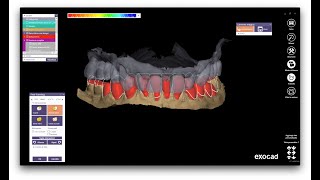 Exocad Example - How to set up a complete lower case of veneers and onlay