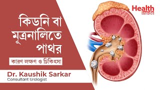 মূত্রনালি ও কিডনিতে পাথর লক্ষণ, কারণ ও চিকিৎসা | Stones in Kidney - Symptoms, causes \u0026 treatment