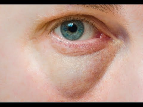 How to Cure Puffy Eyes - Under Eye Bags Home Remedies How to Cure Puffy Eyes - Under Eye Bags Home Remedies