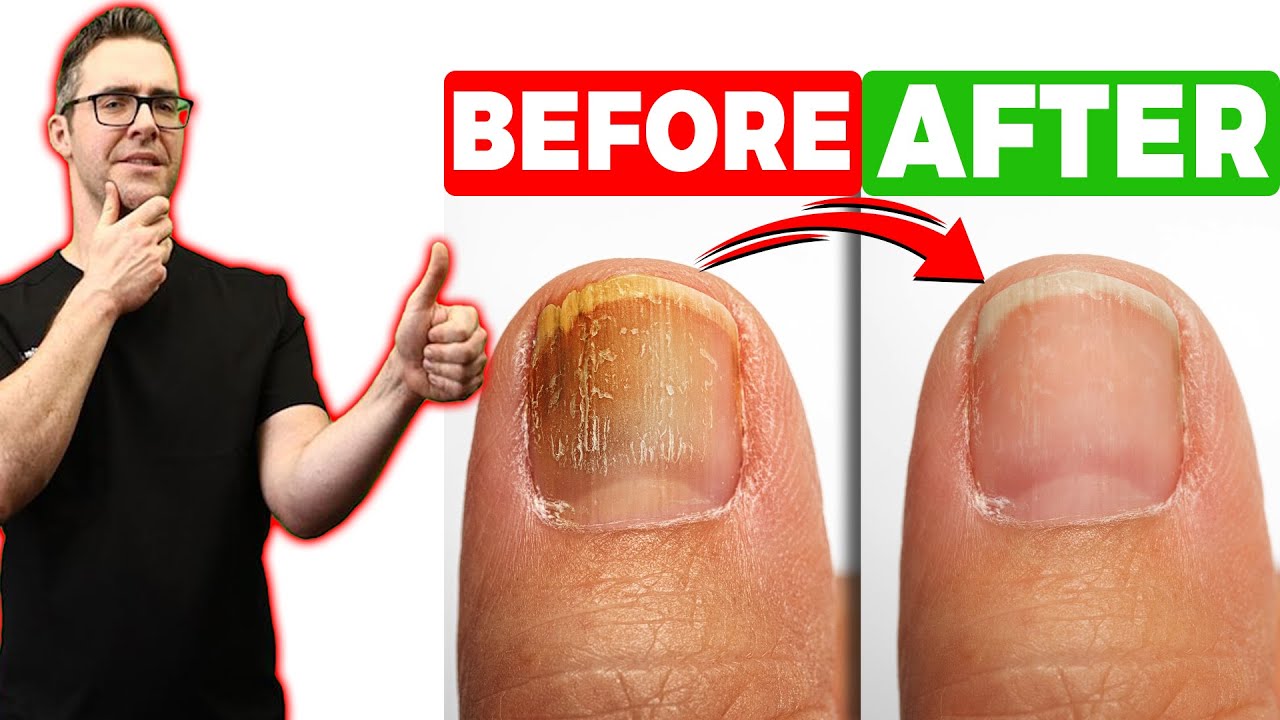 BEST Toenail Fungus Treatment 2024 [+4 BIG SECRETS] - YouTube