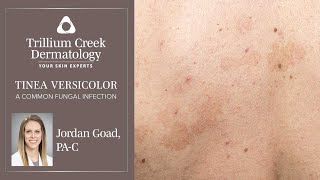 How to spot Tinea Versicolor, a common fungal rash