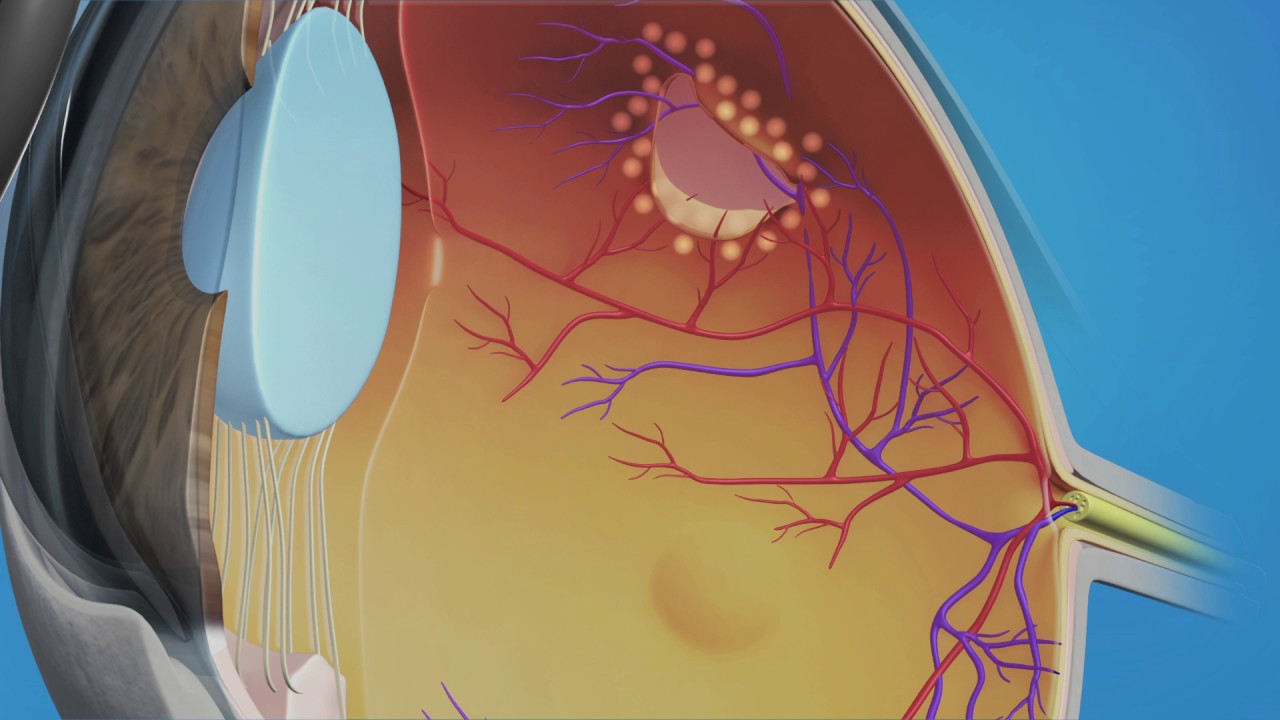 Prophylactic Laser Photocoagulation (Laserpexy) For Retinal Tear - YouTube