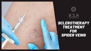 Sclerotherapy Leg Vein Treatment | Spider Veins | Dermatology | ICLS Dermatology \u0026 Plastic Surgery