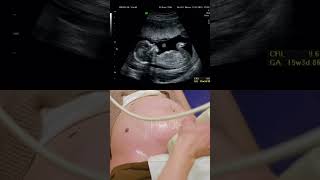 കുഞ്ഞിനെ ആദ്യമായി ultrasound സ്കാനിൽ കണ്ടപ്പോൾ കണ്ണ് നിറഞ്ഞോ🥺❤️#malayalam #pregnancy #fetusgrowth