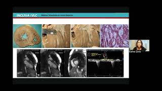 Novedades farmacéuticas y en guías clínicas de la miocardiopatía