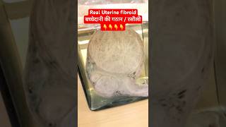 Original Fibroid Uterus | बच्चेदानी की गठान । रसौली  #shorts #trending #shots