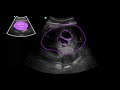 POCUS: 1st Trimester Pregnancy Case 3 - Twin Gestation 6w5d